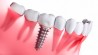 Установка современных зубных имплантов